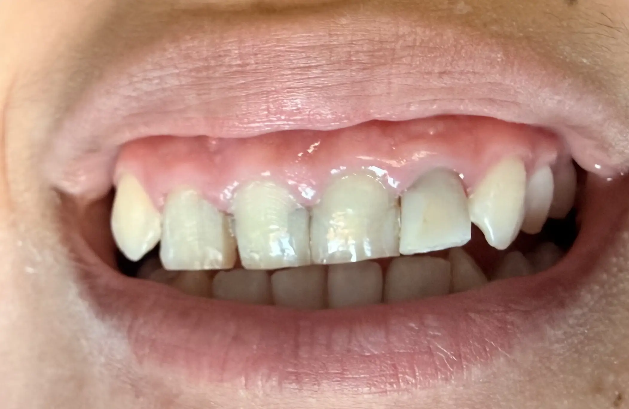 Patient's teeth before full coverage zirconium crown treatment