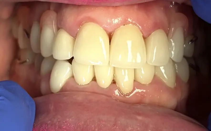 Patient's smile after full mouth crowns and partial dentures at Main Street Smiles, Stoneham MA