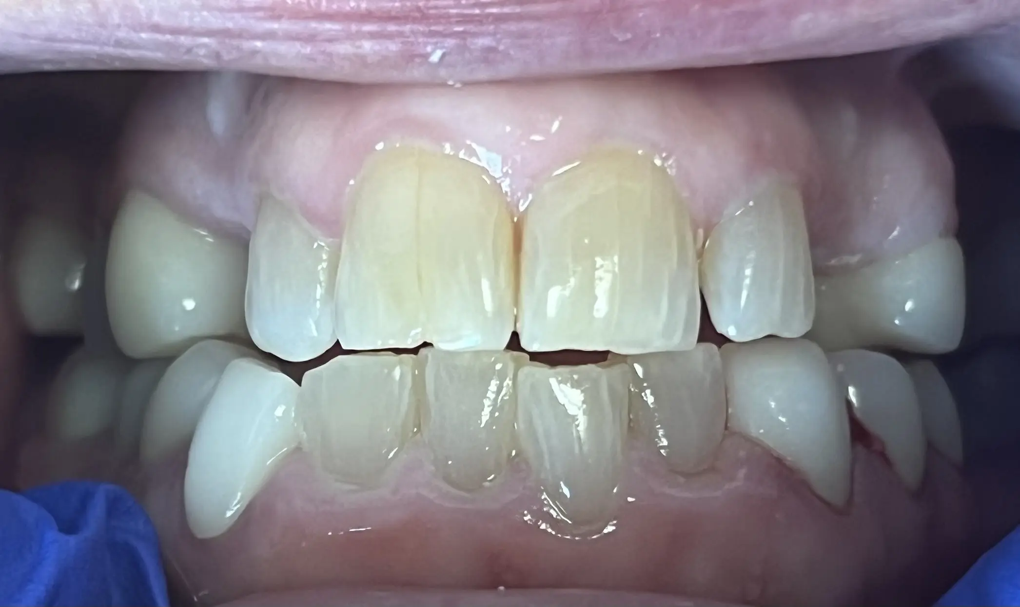 Patient's teeth before full mouth crowns and partial dentures