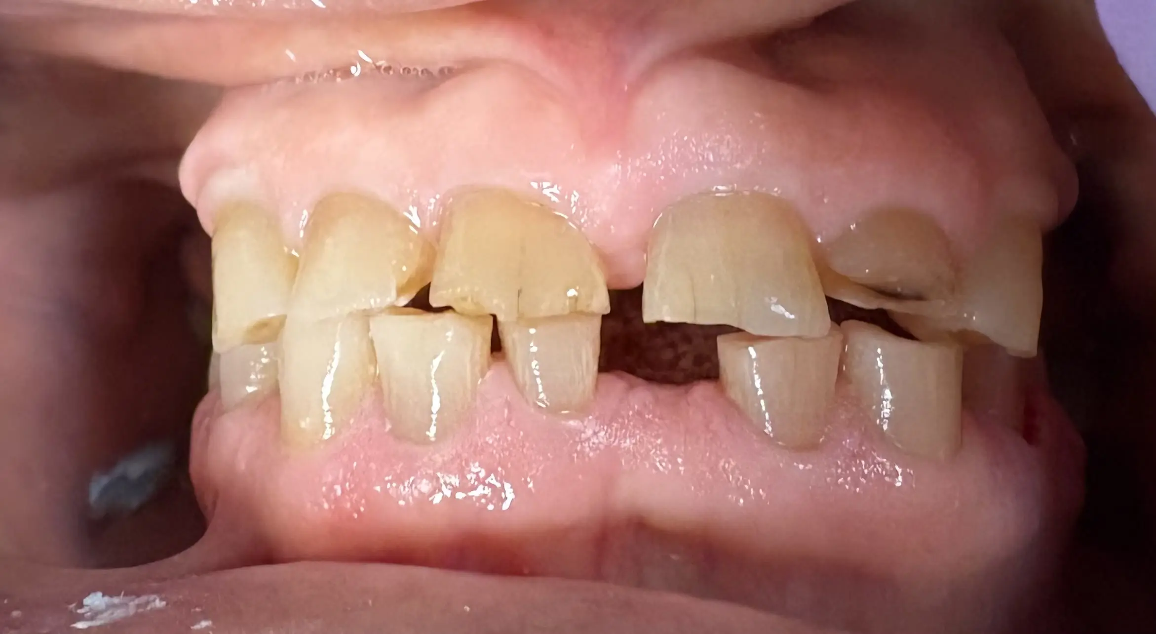 Patient's worn, chipped front teeth with missing lower teeth before treatment